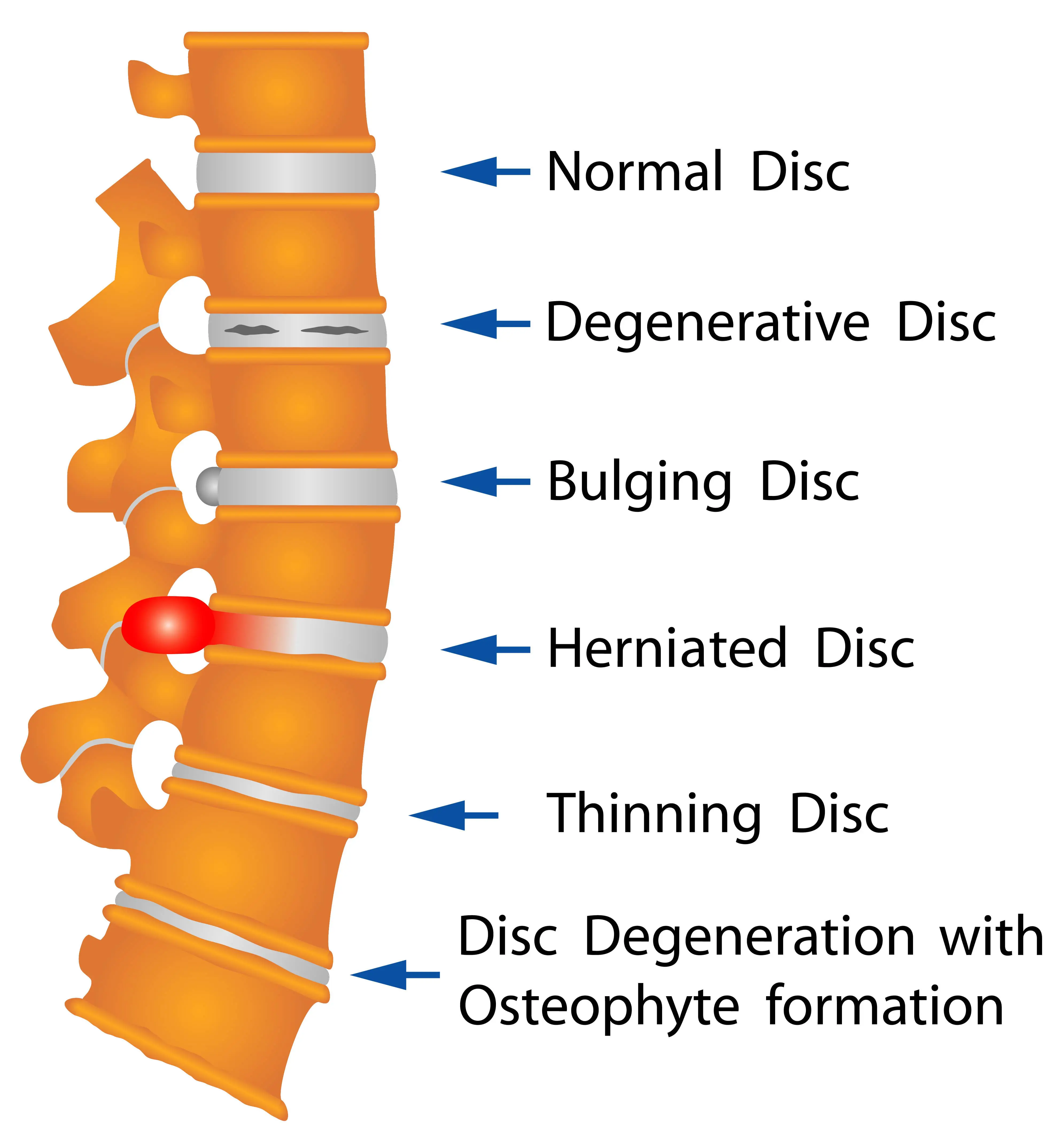 Image of disc disorders that cause back pain