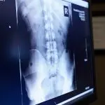 Spinal Xray in the monitor