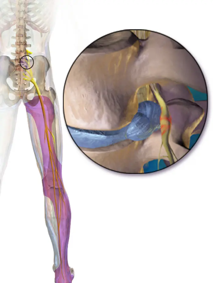 graphic image of sciatic nerve being pinched 