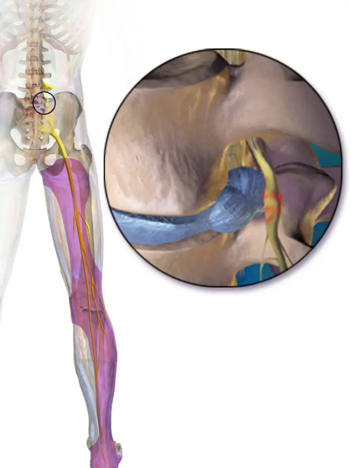 graphic image of sciatic nerve being pinched