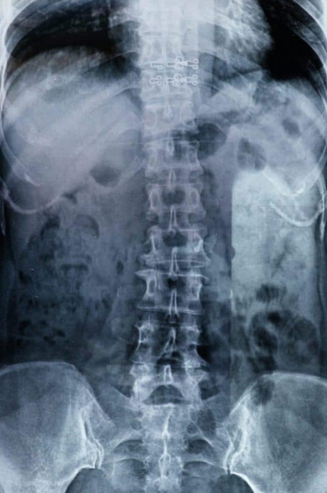 x-ray image of patients back 