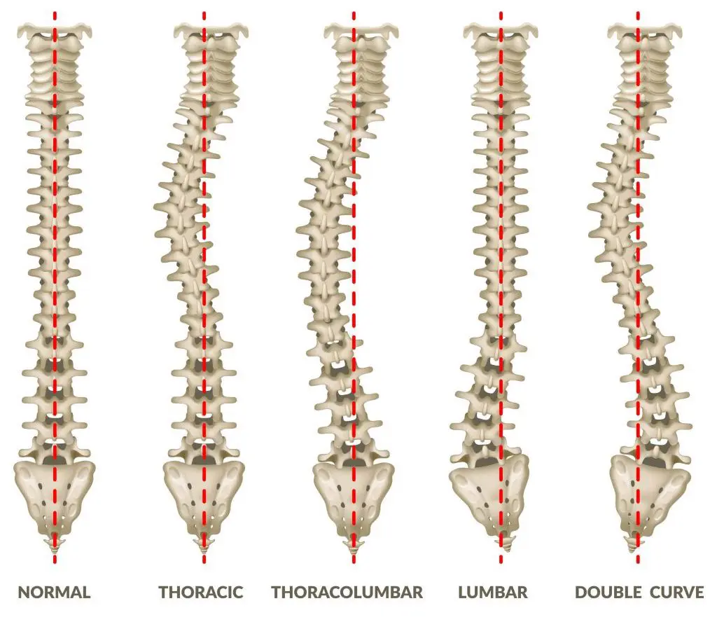 types of scoliosis 