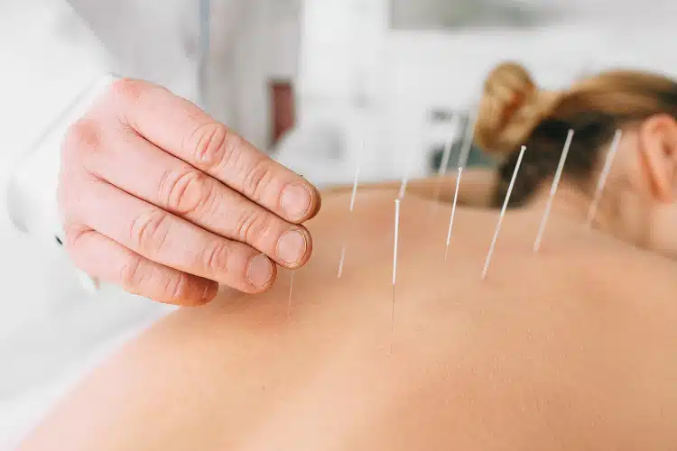Acupuncture therapy for a patient's back discomfort 