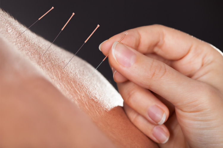 Applying acupuncture to address a patient's pain - acupuncture in west omaha | Kosak