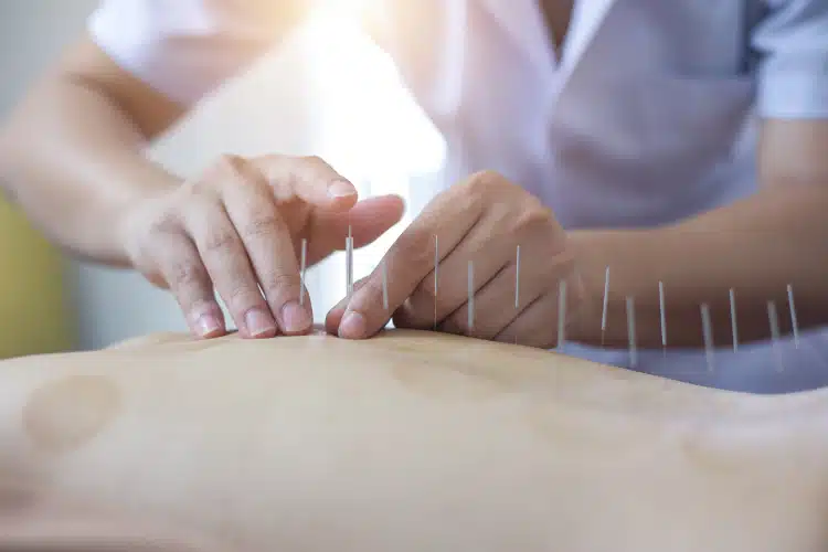 Acupuncture treatment on a patients back - Acupuncture in West Omaha 