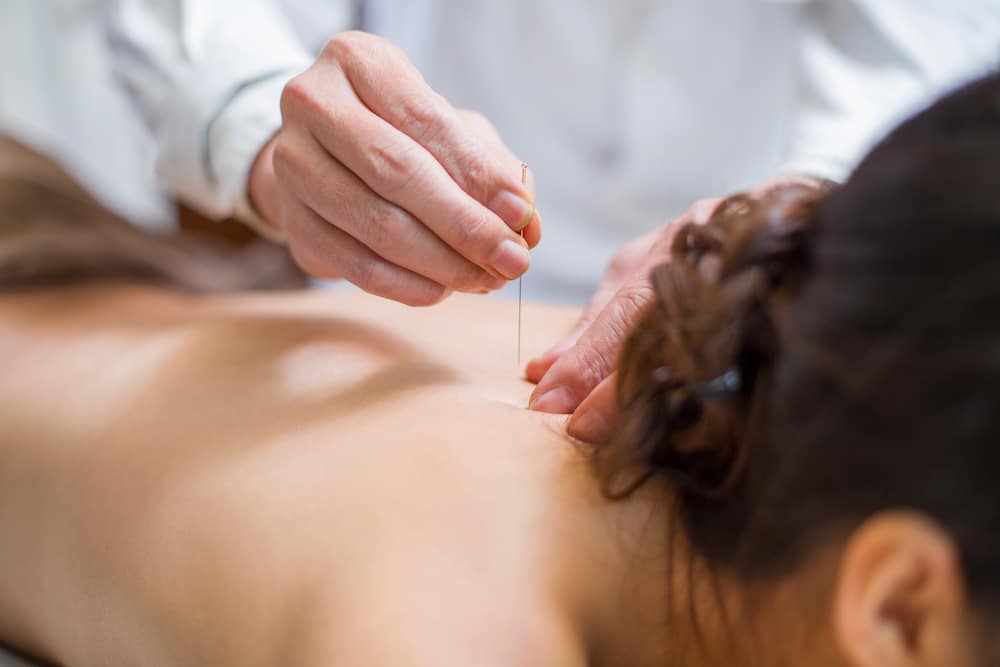 A young woman receiving acupuncture